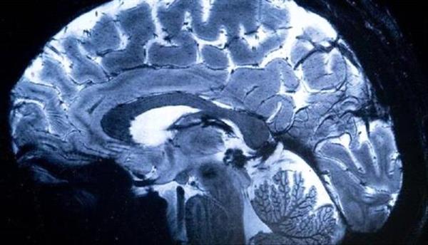 تدريب الذكاء الاصطناعي للكشف عن تضيق الشرايين الدماغية