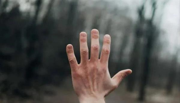 بيحس أنهم مش بتوعه.. رجل يطلب من الطبيب إزالة إصبعين سليمين من يده