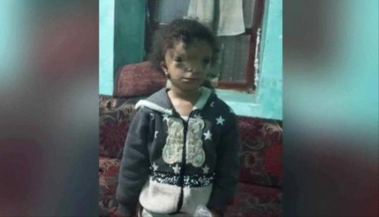بسبب تشوهات خلقية في وجه طفلته..يمني يعرض كليته للبيع
