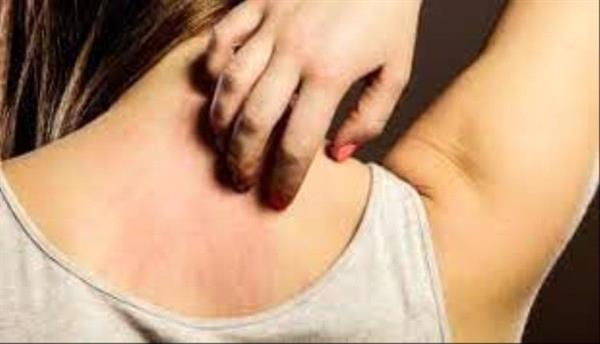 6 أسباب للطفح الجلدي في الشتاء.. اعرفها
