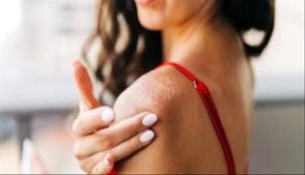 وصفات طبيعية للتخلص من حروق الشمس.. جل الصبار والزبادي الأبرز
