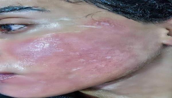 "جريمةٌ بشعةٌ في تعز اليمنية: سائق دراجة نارية يحرق شابًا بمادة الأسيت"
