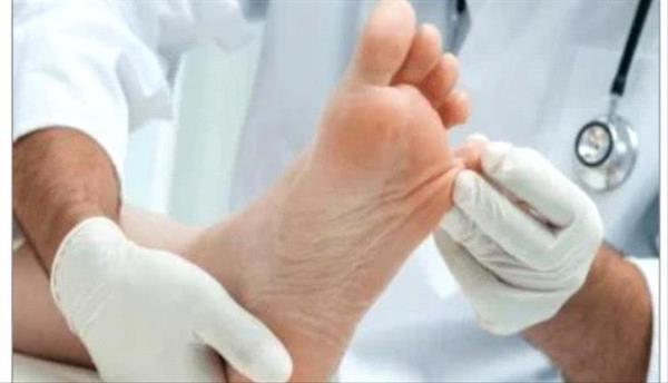 نصائح فعالة لتجنب انتفاخات القدمين في الطقس الحار
