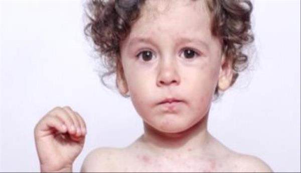 لماذا يصاب الأطفال ببثور الظهر والوجه؟