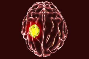 علاج رائد يُخلّص طبيبا من ورم دماغي غير قابل للشفاء