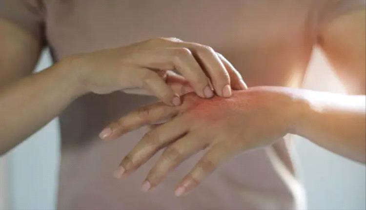 علاج الصدفيه نهاتيا دليل شامل للتخلص من هذا المرض الجلدي
