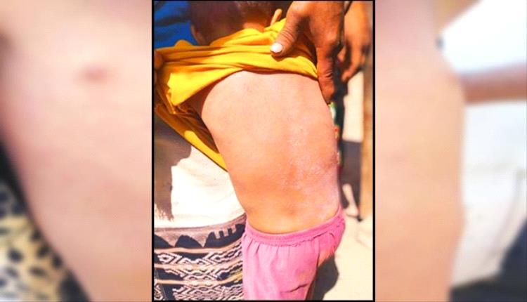 تفشي الحصبة في أبين والضالع يتسبب في وفيات.. ونداءات عاجلة للتدخل