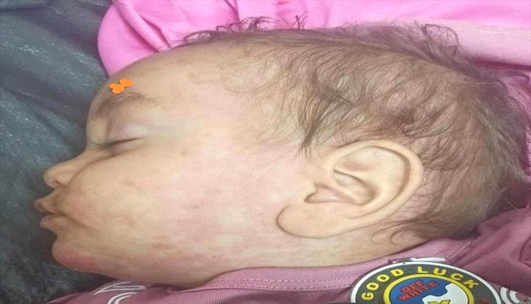 انتشار مخيف لمرض الحصبة في مسيمير لحج والأهالي يناشدون السلطات الصحية

