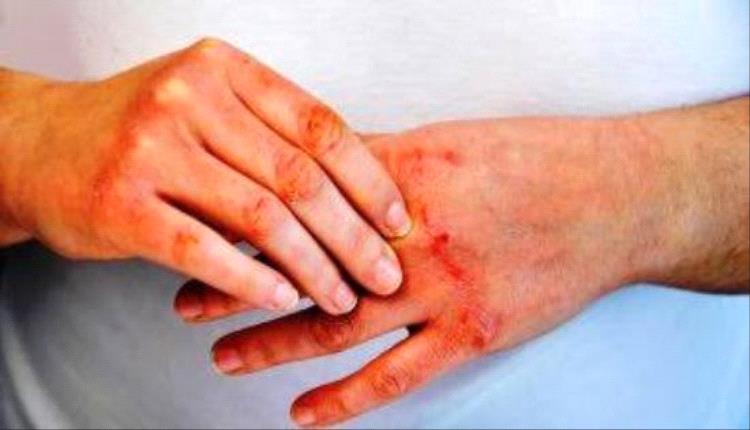 أقمشة الأطفال المعالجة بمبيد تقلل الملاريا