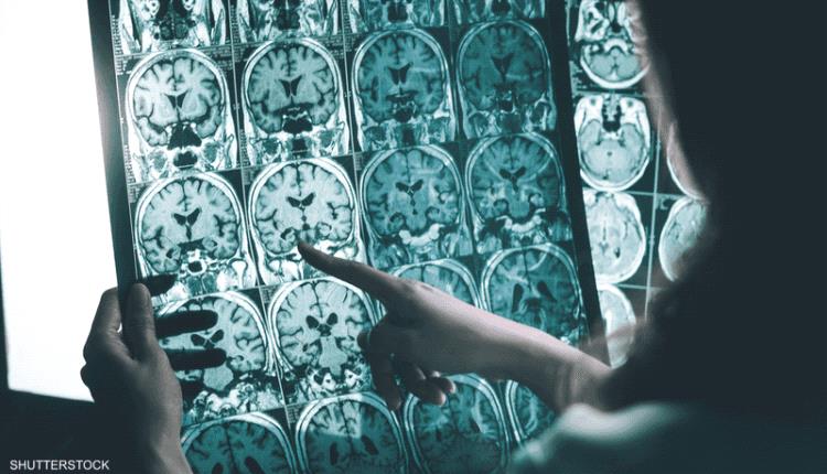 مرحلة ما قبل الأعراض.. دواء جديد يستهدف "شرارة" الزهايمر