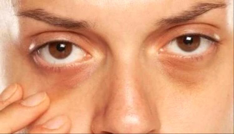 الهالات السوداء قد تكون علامة على هذه المشكلات الصحية
