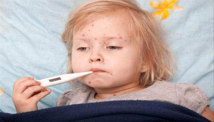 تحذير طبي: الحصبة شديدة العدوى وتُصيب 9 من كل 10 أشخاص غير ملقحين