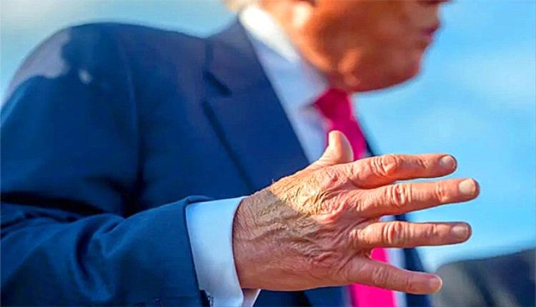 ترامب يعاني من القصور الوريدي المزمن.. والبيت الأبيض يؤكد سلامة حالته الصحية