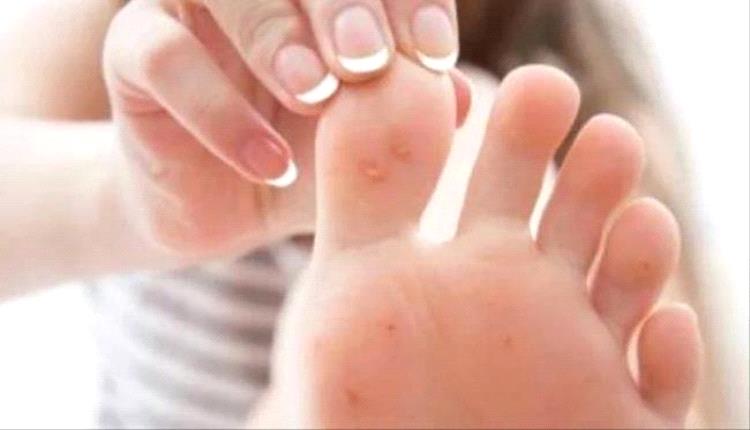 برودة القدمين مؤشر أمراض خطرة
 
