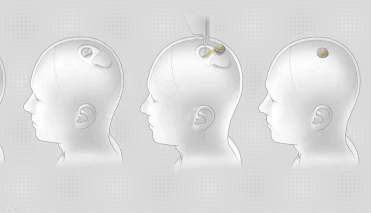 بشرى لمرضى الشلل.. شريحة في الدماغ قد تتيح التحكم بالأدوات