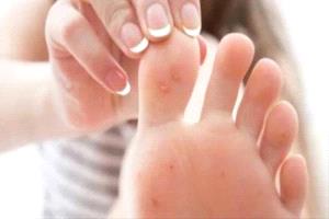 برودة القدمين مؤشر أمراض خطرة
 
