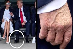 كدمات غامضة وتشخيص بمرض مزمن يثير القلق حول صحة ترامب
