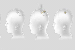 بشرى لمرضى الشلل.. شريحة في الدماغ قد تتيح التحكم بالأدوات