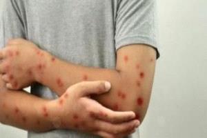 غينيا تعلن حالة طوارئ صحية بعد تسجيل أكثر من 300 إصابة بجدري القردة
