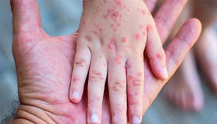 منظمة الصحة العالمية تُجدد تحذيرها من تفشي جدري القردة وتُصدر توصيات جديدة