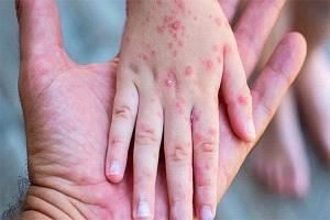 منظمة الصحة العالمية تُجدد تحذيرها من تفشي جدري القردة وتُصدر توصيات جديدة