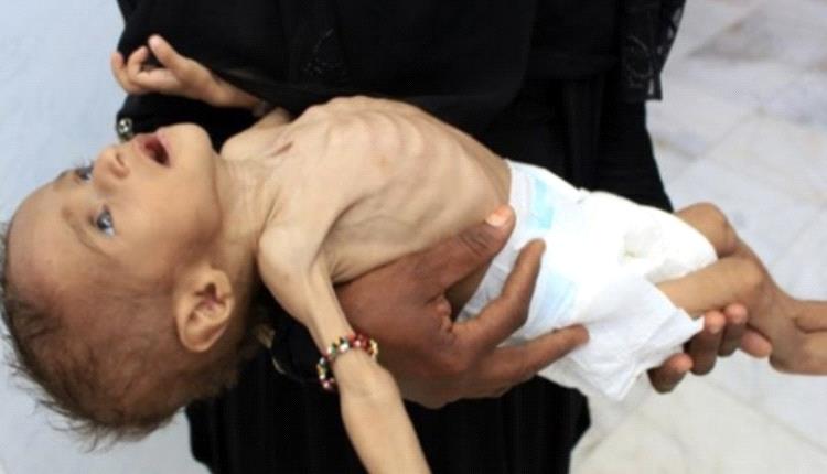 اليونيسف تطلق مبادرة تغذوية لتسريع الحد من نقص التغذية في اليمن