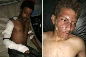 "شبو حوثي" يُشعل جريمة مروعة: إحراق شابين أحياءً على يد متعاطٍ هائج