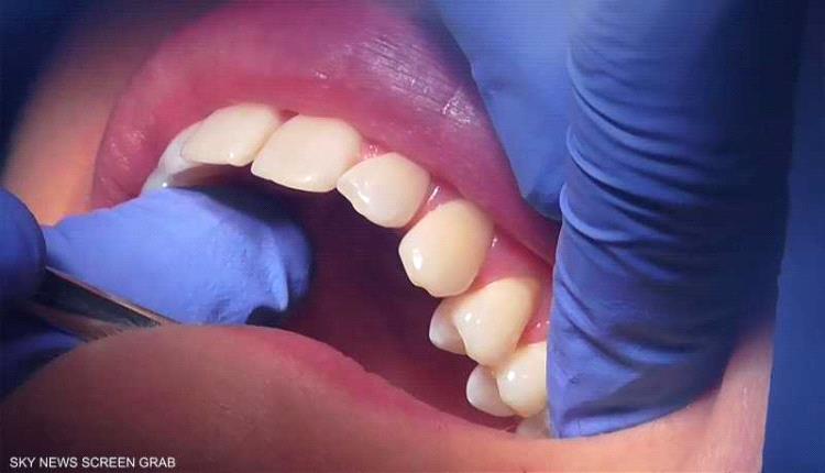 علماء يطورون هلاما لإصلاح الأسنان التالفة دون جراحة