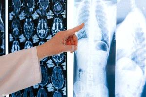 علاجات حديثة تزيد فرص النجاة من سرطان الرئة عالميا