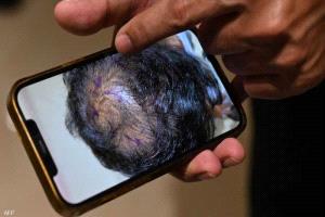 ابتكار مصل لعلاج تساقط الشعر في قرابة 20 يوما