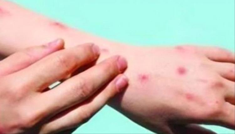 غانا تواجه جدري القرود 446 إصابة وحالة وفاة واحدة

