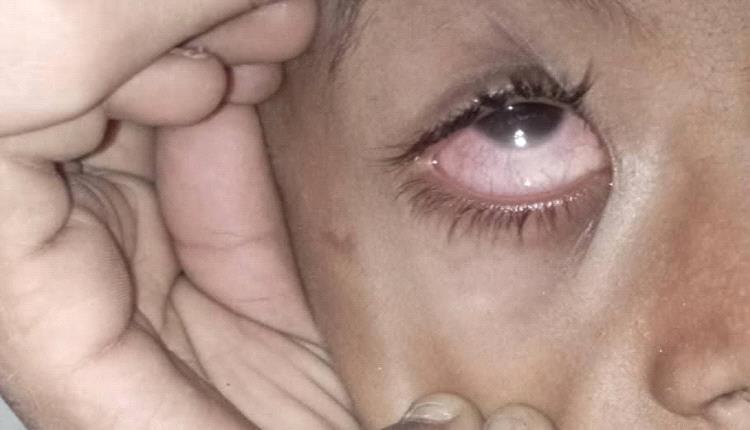 دعوة عاجلة لإنقاذ طفل مهدد بفقدان النظر