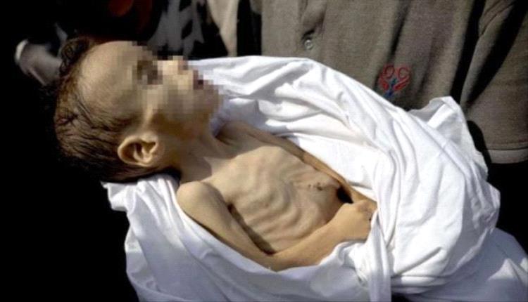 ارتفاع ضحايا المجاعة في غزة إلى 420 وفاة بينهم 145 طفلاً
