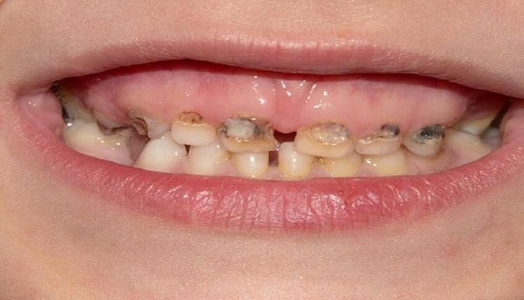 خطر خفي في المنازل… التدخين السلبي يهدد أسنان الأطفال