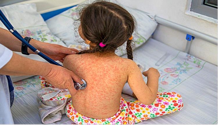 مدير صحة الشيخ عثمان يحذر من تفشي الحصبة ويدعو لتلقي اللقاح فوراً