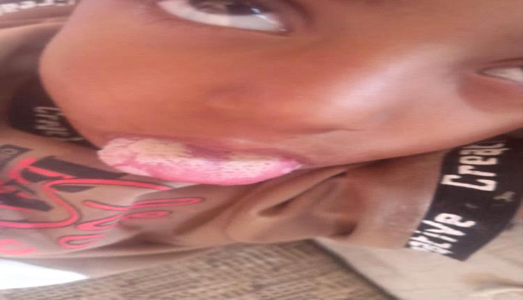 انتشار عدوى فطرية بين الأطفال في تورصة بالضالع ومناشدات عاجلة للتدخل الصحي