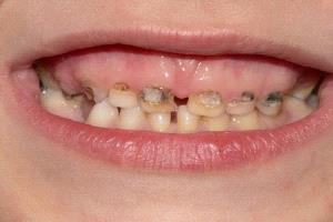 خطر خفي في المنازل… التدخين السلبي يهدد أسنان الأطفال