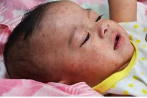 تقرير رسمي: 819 إصابة بالحصبة في تعز منذ مطلع العام الجاري