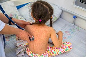 مدير صحة الشيخ عثمان يحذر من تفشي الحصبة ويدعو لتلقي اللقاح فوراً