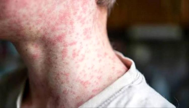 الحصبة تضرب بنسلفانيا بقوة وتسجل 460 إصابة
