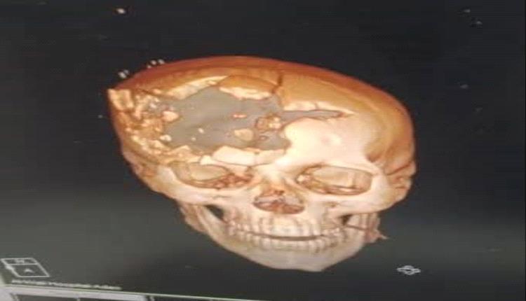 رصاصة تتجاوز الحرب إلى الجريمة.. طبيب يقرع ناقوس الخطر بشأن أسلحة محرّمة في ساحات القتال