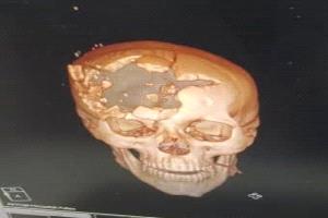 رصاصة تتجاوز الحرب إلى الجريمة.. طبيب يقرع ناقوس الخطر بشأن أسلحة محرّمة في ساحات القتال