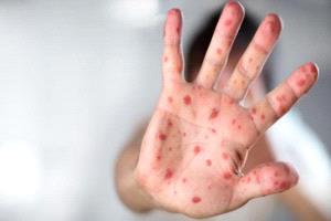 حصبة تجتاح إسرائيل: 14 وفاة وآلاف الإصابات