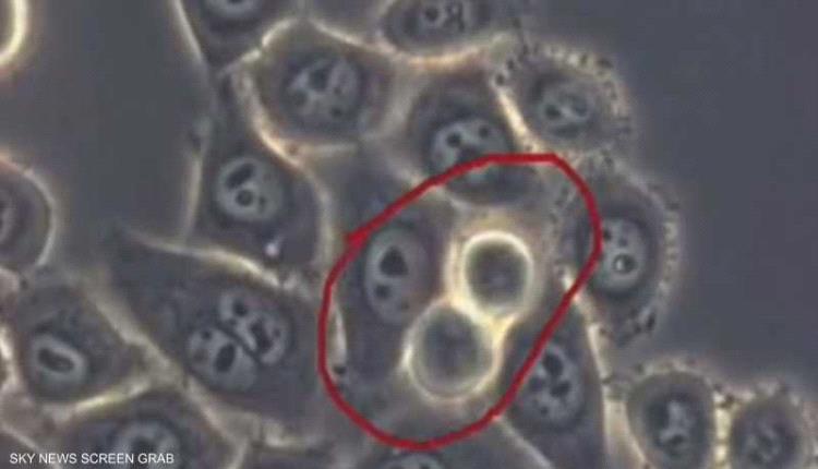 كشف سرطان البنكرياس.. 