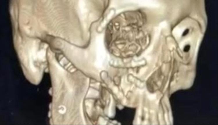 نجاح طبي متميز في مستشفى أجا لإعادة بناء وجه مصاب بحادث