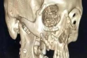 نجاح طبي متميز في مستشفى أجا لإعادة بناء وجه مصاب بحادث