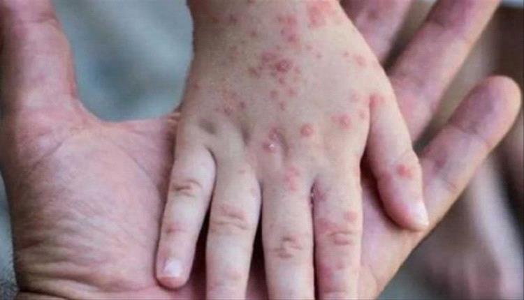 الصين تطبق إجراءات صارمة لاحتواء جدري القردة على غرار كوفيد-19