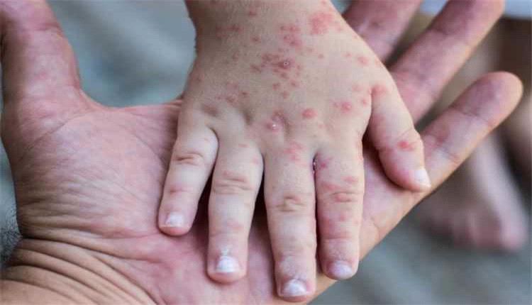 اليمن تسجل نحو 13 ألف إصابة بالحصبة و71 حالة وفاة منذ مطلع العام