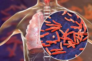طريقة مبتكرة لعلاج مرض السل