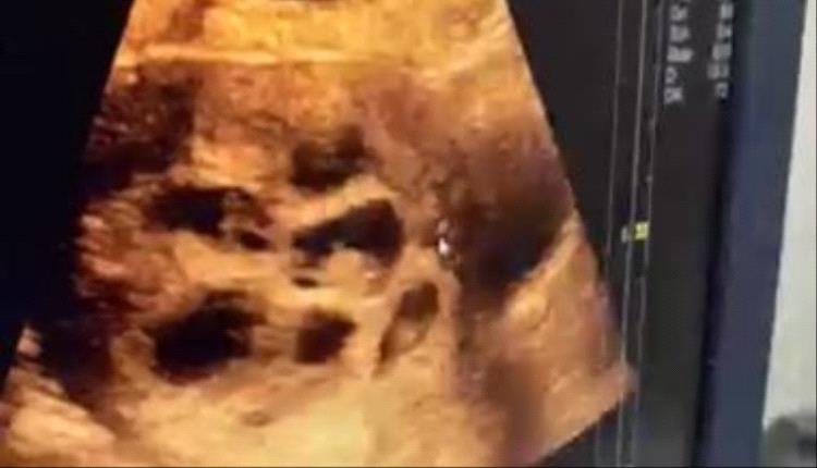 سيدة قنائية تحمل 8 توائم طبيعيًا بعد 4 سنوات من العقم.. حالة نادرة قد تدخل موسوعة جينيس